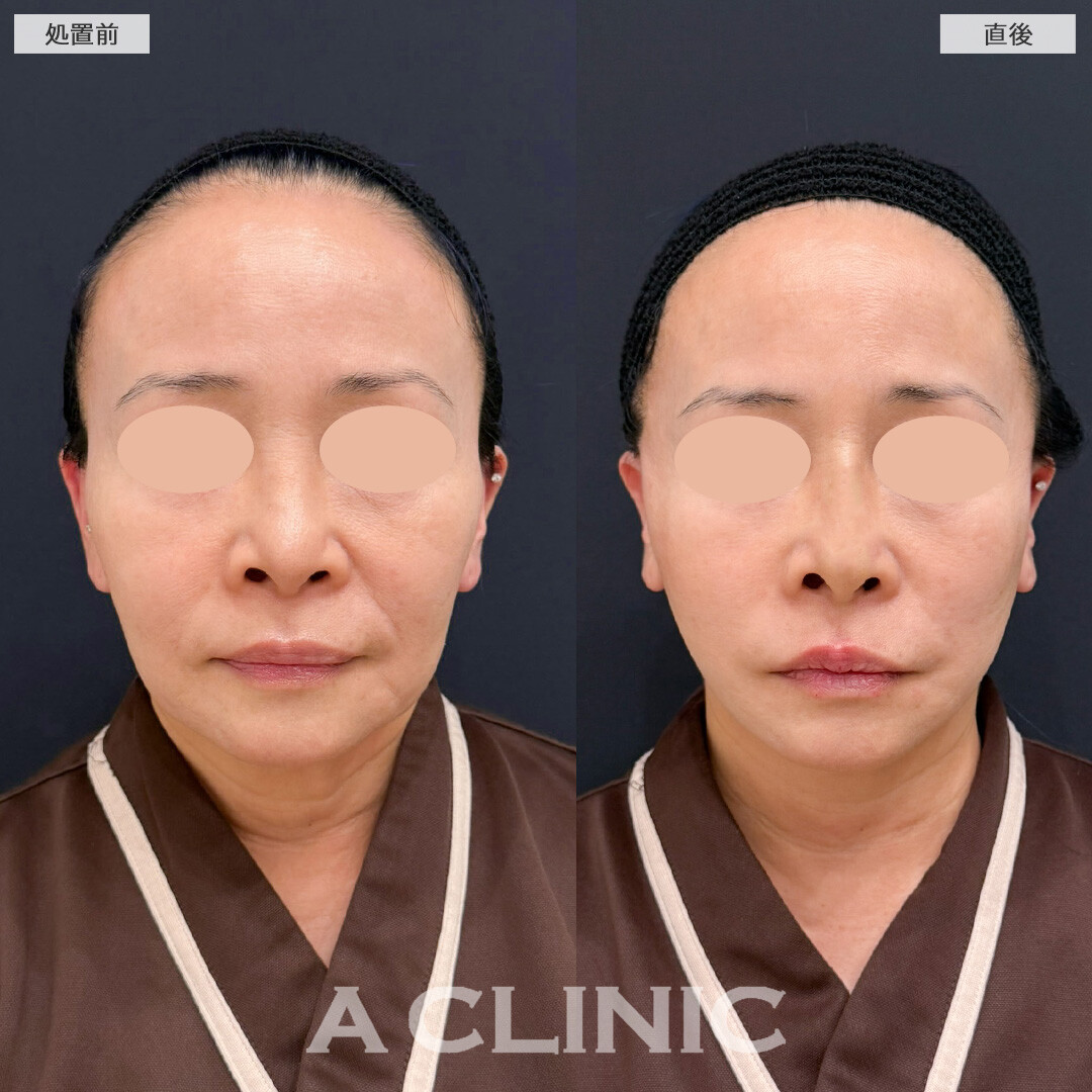 Aスレッドでしっかり引き上げて直後から若返り効果を実感！こちら処置前と直後の症例です(60代女性)
