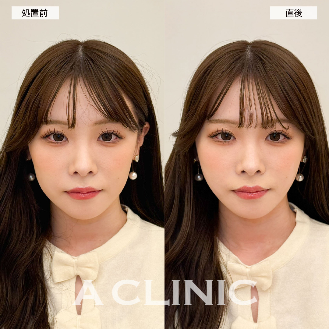 Aスレッドで左右差のない美しいファイスラインに！こちら処置前と直後の症例です(20代女性)
