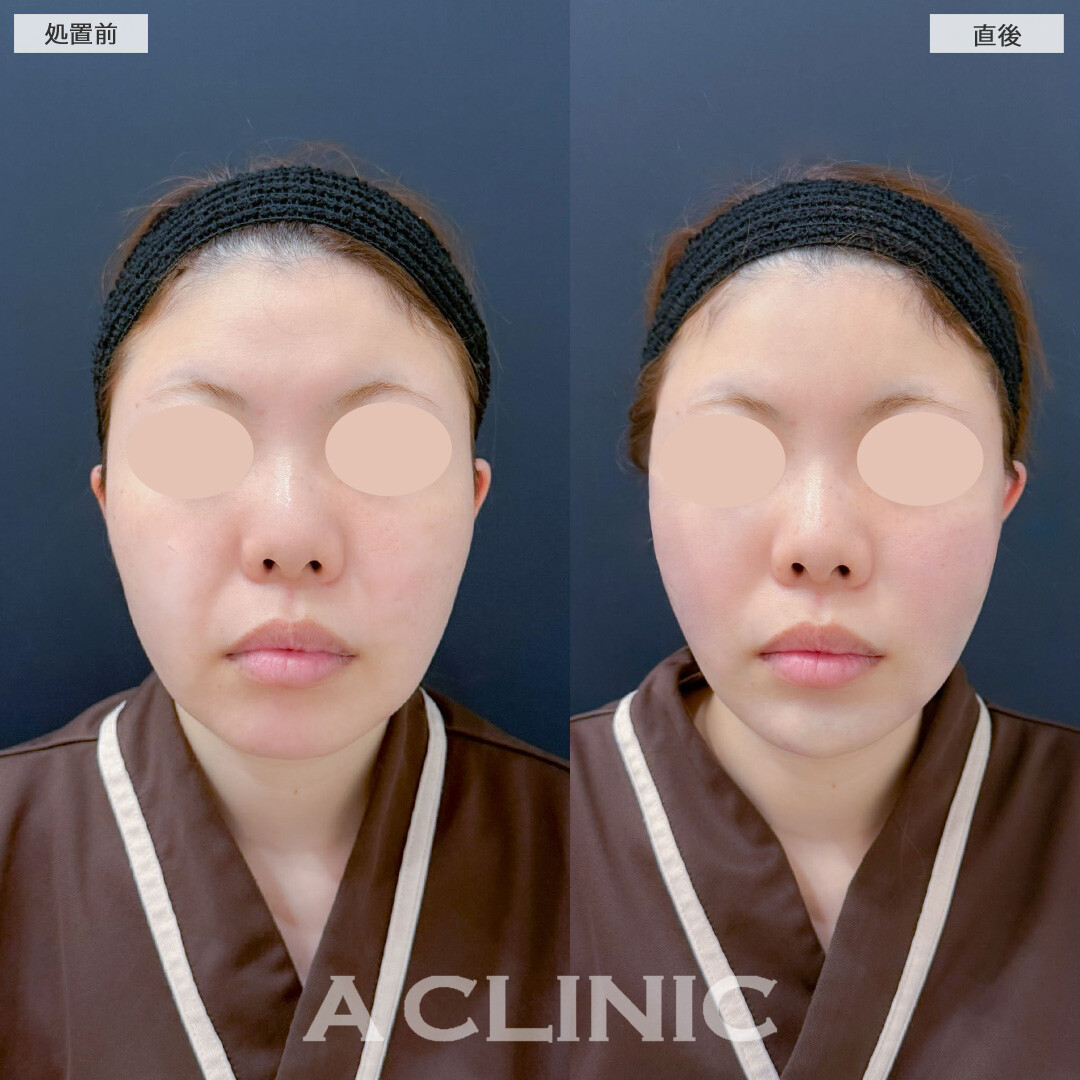 Aスレッドとあごへのヒアルロン酸注入で直後からダウンタイム少なくEラインが整いました！こちら処置前と直後の症例です(30代女性)