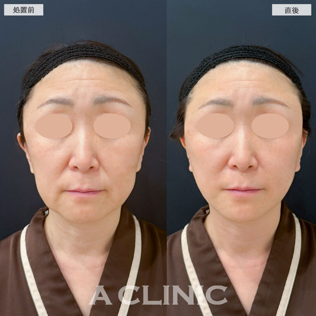 Aスレッドでたるみが解消され若々しい印象になりました！こちら処置前と直後の症例です(40代女性)