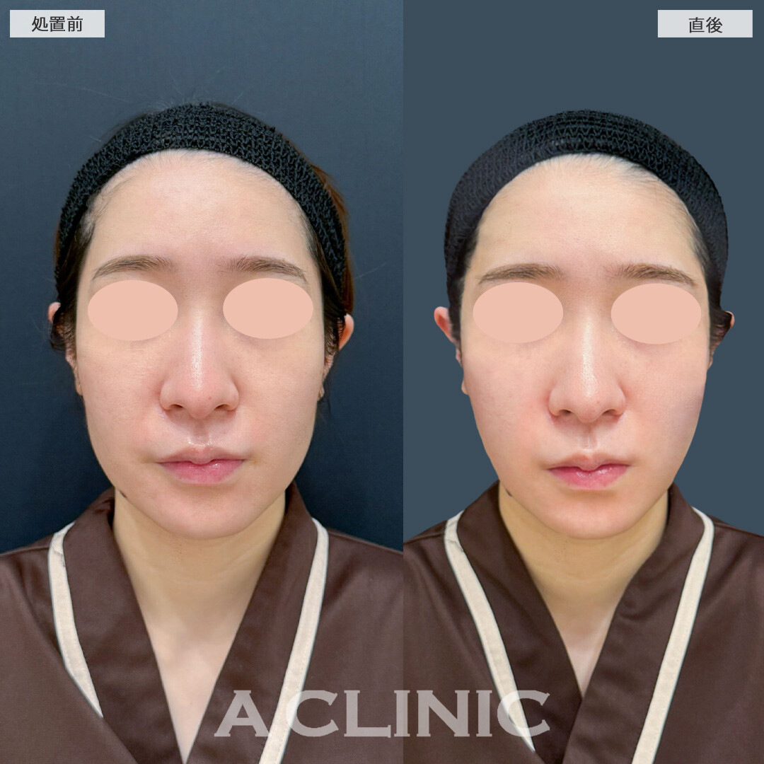 Aスレッドでたるみがナチュラルに引きあがりました！こちら処置前と直後の症例です(20代女性)