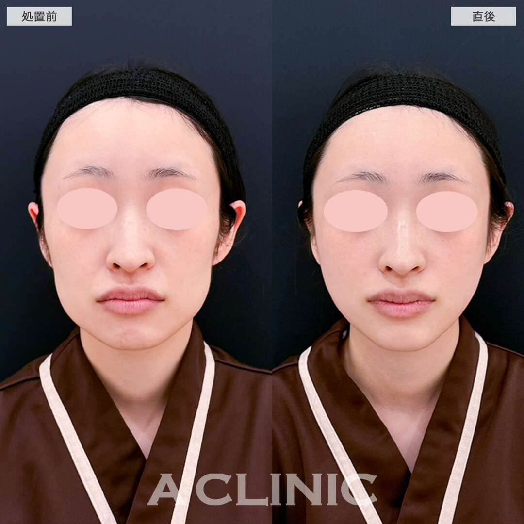 Aスレッドと頬へのヒアルロン酸注入で凹凸フェイスを即日改善！こちら処置前と直後の症例です(30代女性)