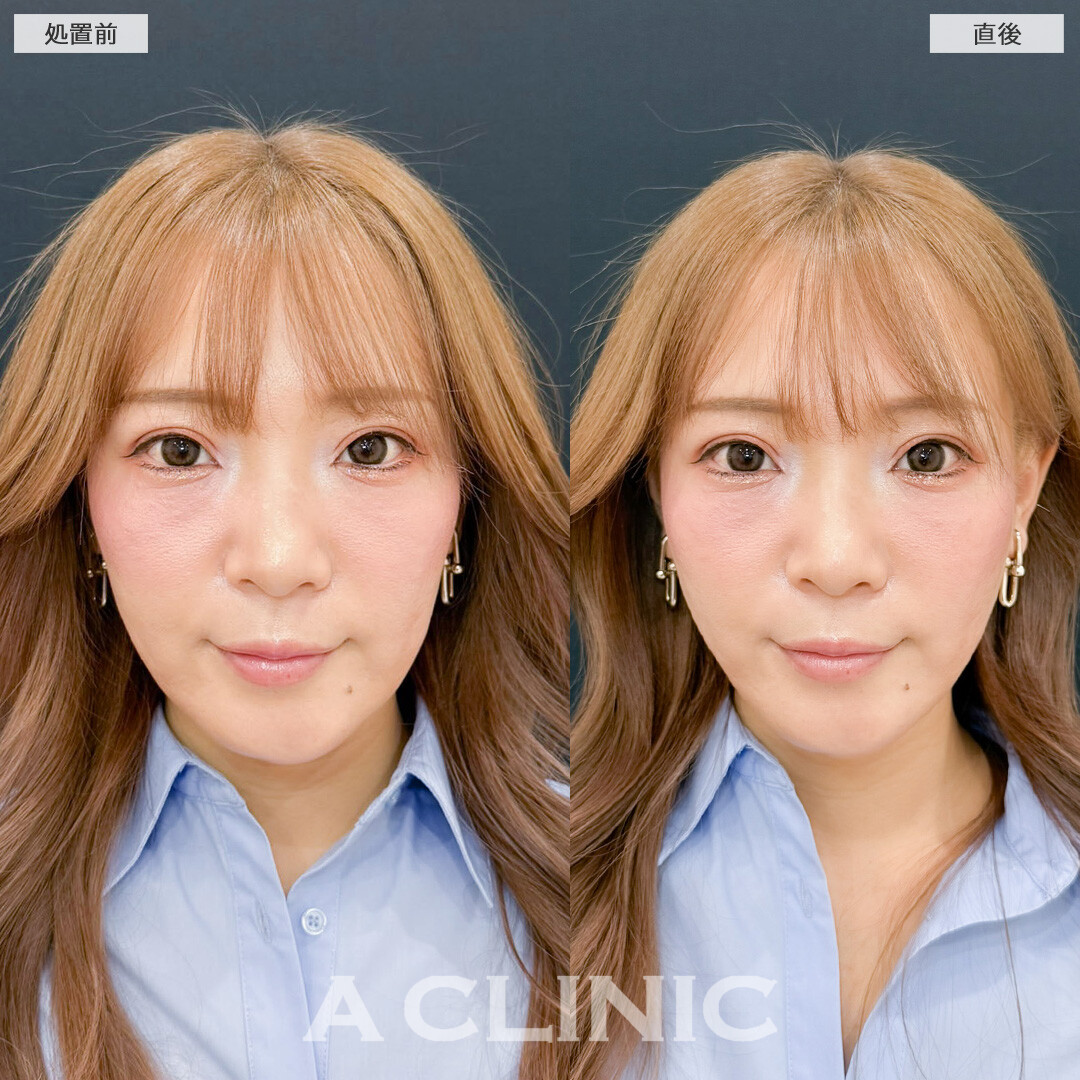 Aスレッドはアンチエイジングのためのメンテナンスに最適です！こちら処置前と直後の症例です(30代女性)