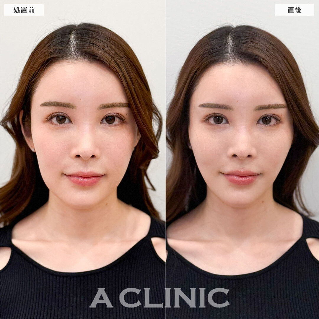 Aスレッドなら直後からもたつき解消して理想の輪郭が叶う！こちら処置前と直後の症例です(30代女性)