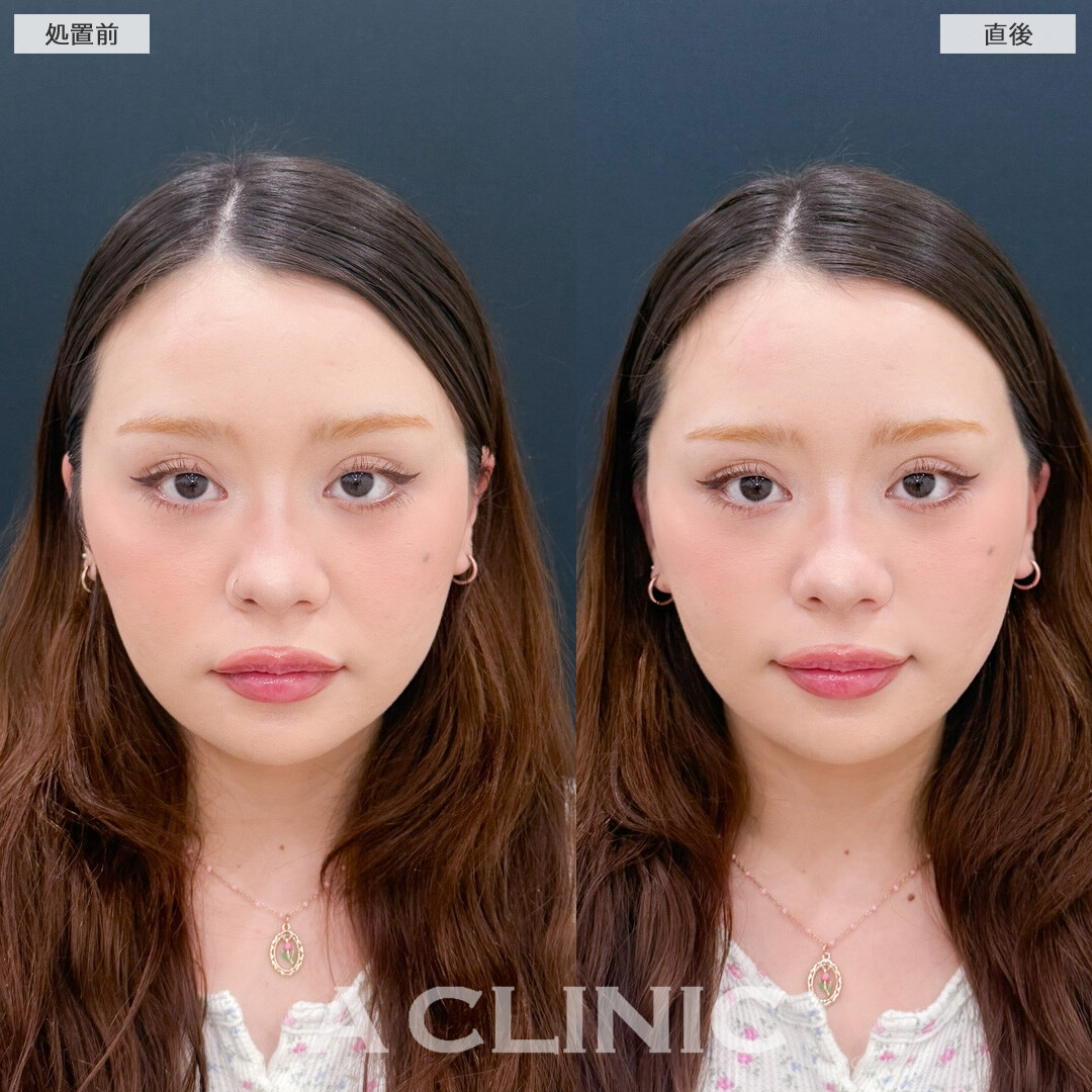 Aスレッドでその日のうちになりたい小顔に！こちら処置前と直後の症例です(20代女性)