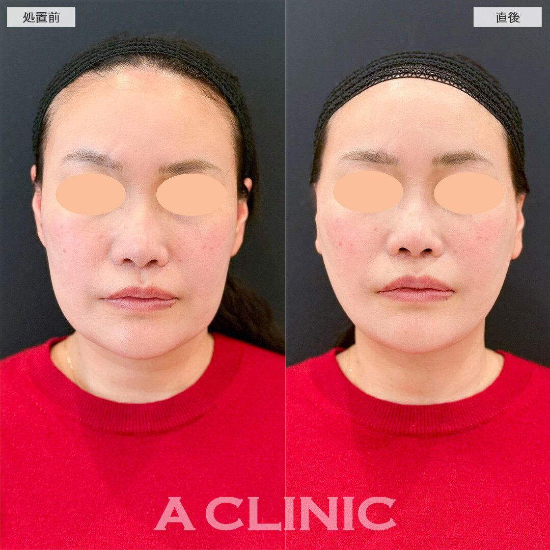 Aスレッドで凹凸の無い綺麗な卵型の輪郭に変化しました！処置前と直後の症例です(40代女性)