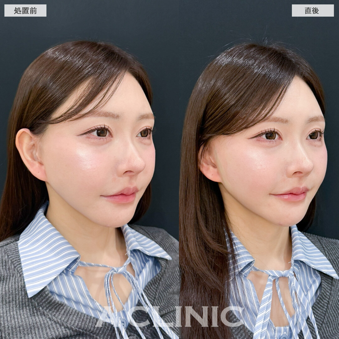 Aスレッドでナチュラルにリフトアップに成功しました！処置前と直後の症例です(30代女性)