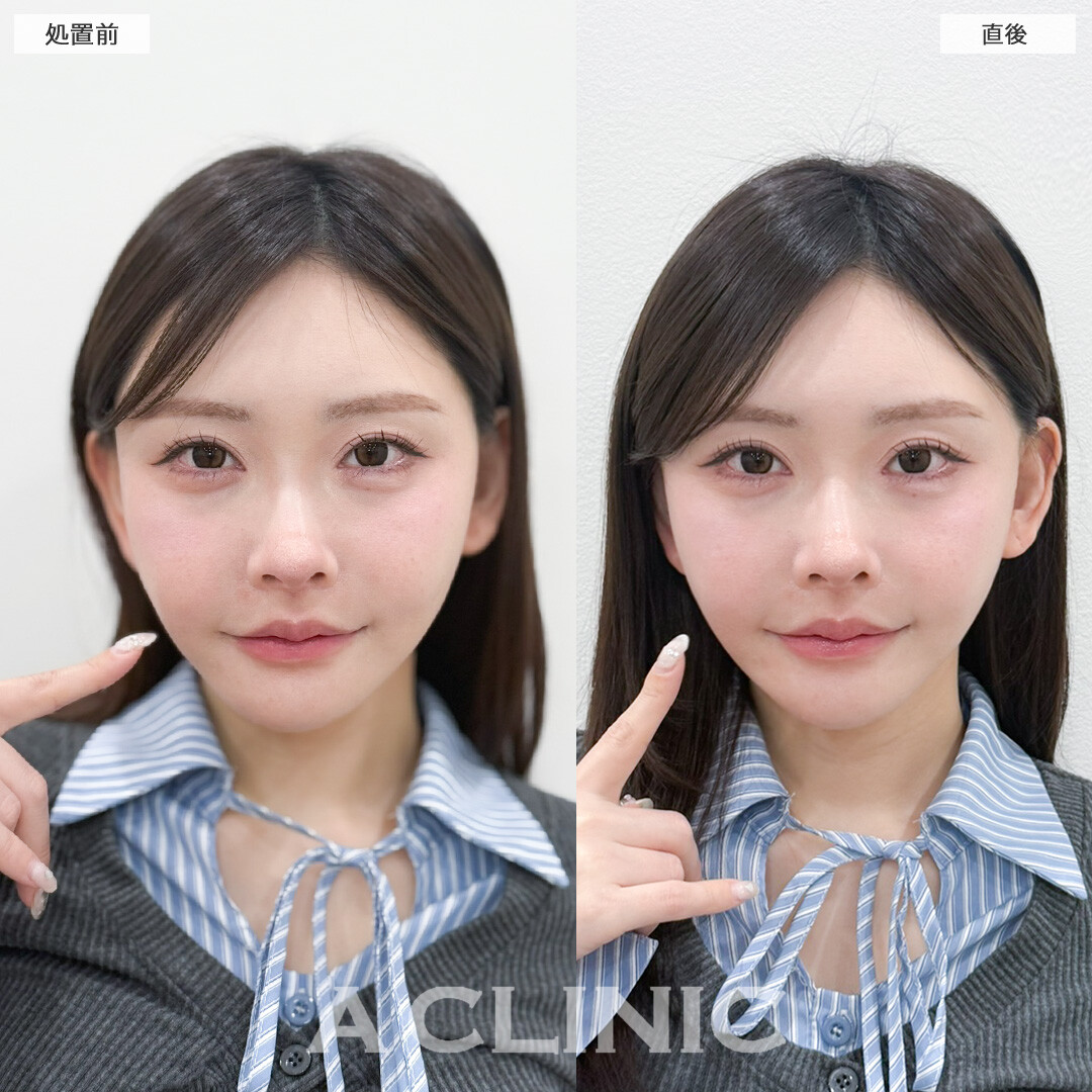 Aスレッドでナチュラルにリフトアップに成功しました！処置前と直後の症例です(30代女性)