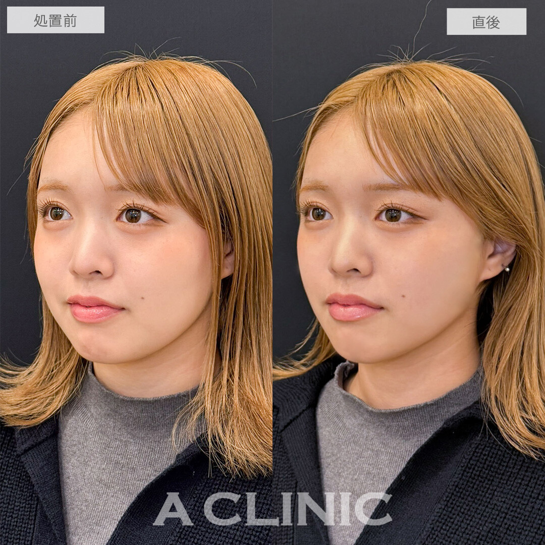 Aスレッドで口横のもたつきとほうれい線改善しました！こちら処置前と直後の症例です(20代女性)