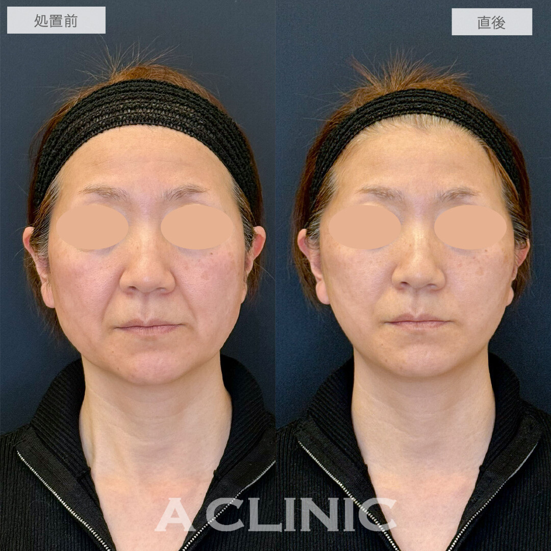 Aスレッドでほうれい線が薄くなり若返りました！こちら処置前と直後の症例です(50代女性)