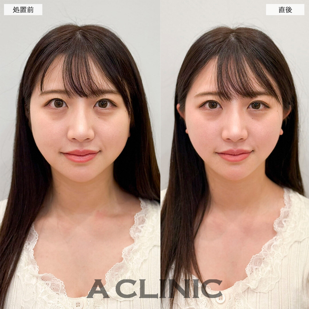 Aスレッドで自然に痩せたようなフェイスラインに！処置前と直後の症例です(30代女性)