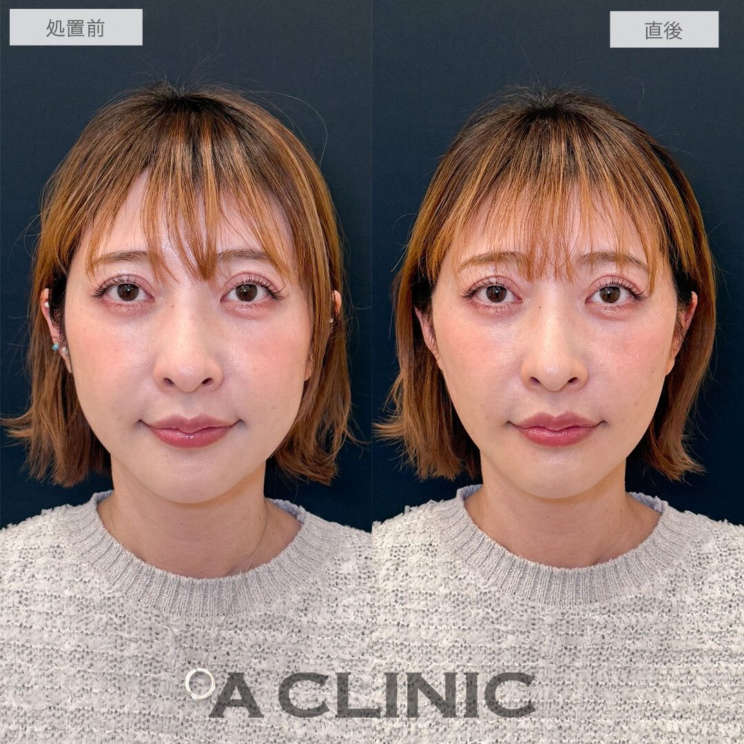 Aスレッドで口元のもたつき改善しスッキリとした輪郭になりました！こちら処置前と直後の症例です(40代)