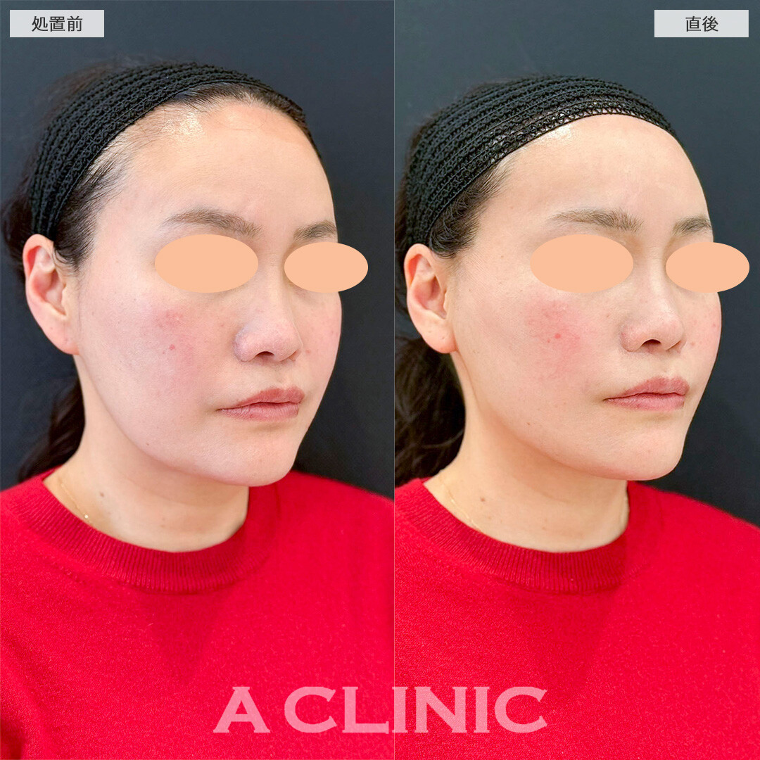 Aスレッドで凹凸の無い綺麗な卵型の輪郭に変化しました！処置前と直後の症例です(40代女性)