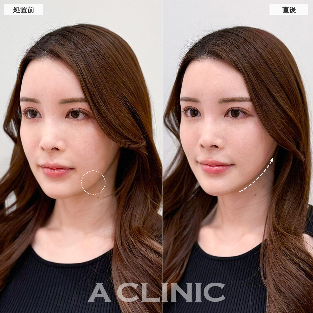 Aスレッドなら直後からもたつき解消して理想の輪郭が叶う！こちら処置前と直後の症例です(30代女性)