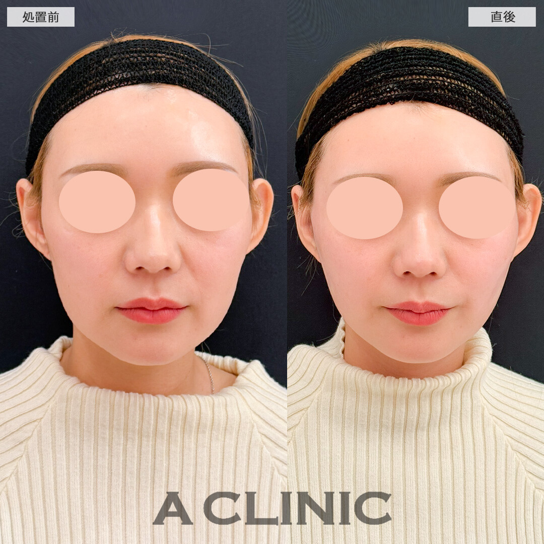 Aスレッドでシャープなフェイスラインになりました！処置前と直後の症例です(30代女性)
