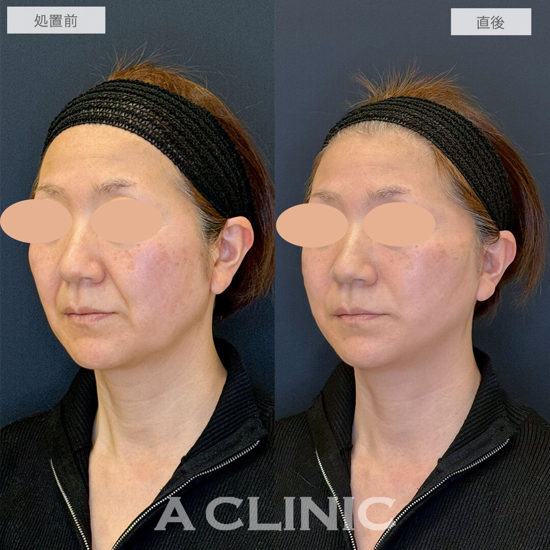 Aスレッドでほうれい線が薄くなり若返りました！こちら処置前と直後の症例です(50代女性)