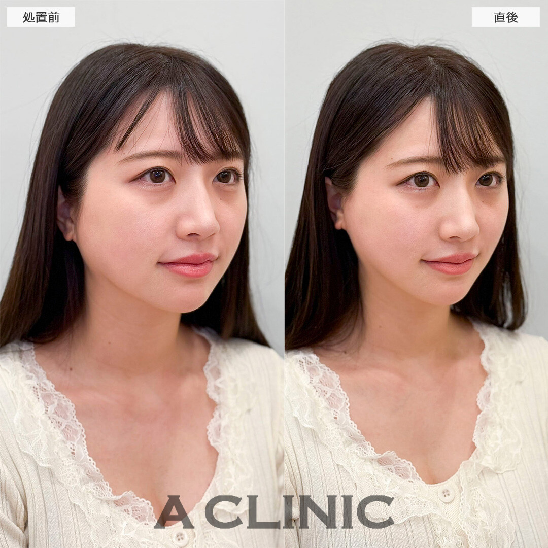 Aスレッドで自然に痩せたようなフェイスラインに！処置前と直後の症例です(30代女性)