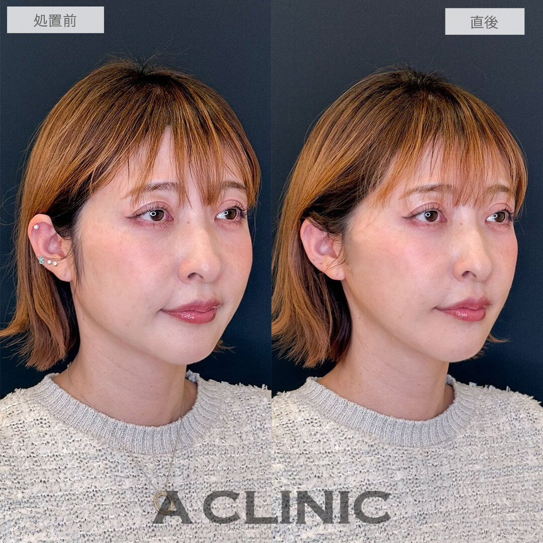 Aスレッドで口元のもたつき改善しスッキリとした輪郭になりました！こちら処置前と直後の症例です(40代)