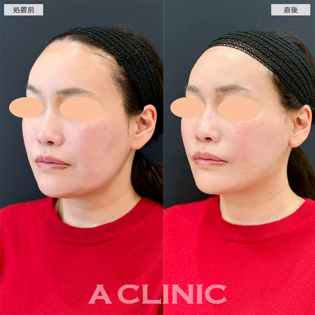 Aスレッドで凹凸の無い綺麗な卵型の輪郭に変化しました！処置前と直後の症例です(40代女性)