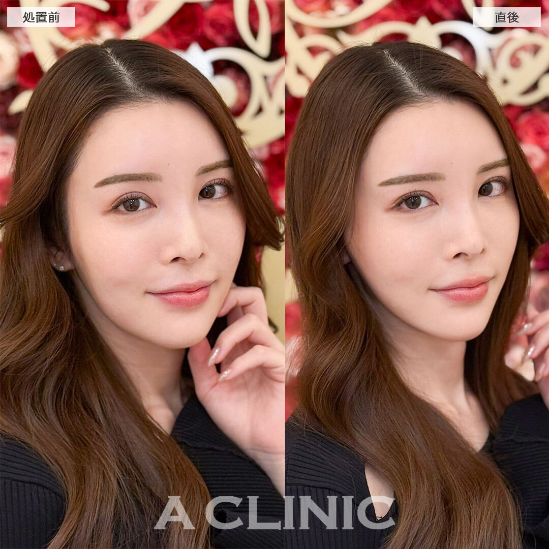 Aスレッドなら直後からもたつき解消して理想の輪郭が叶う！こちら処置前と直後の症例です(30代女性)