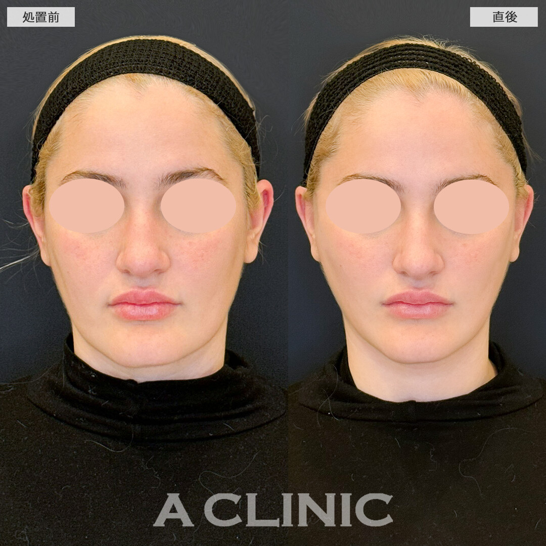 Aスレッドで凹ついたフェイスラインもスッキリVフェイスに変化！処置前と直後の症例です(30代女性)