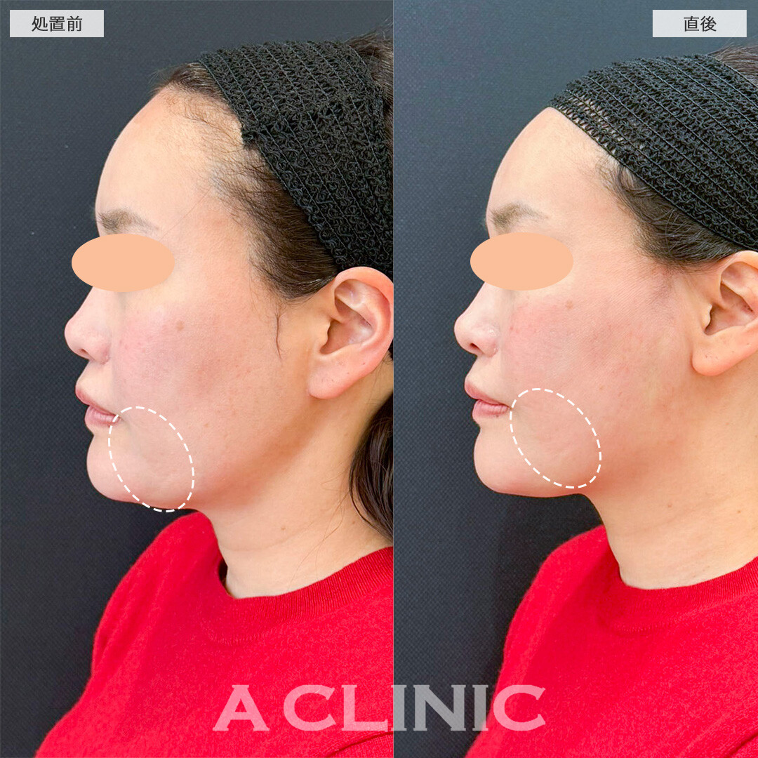 Aスレッドで凹凸の無い綺麗な卵型の輪郭に変化しました！処置前と直後の症例です(40代女性)