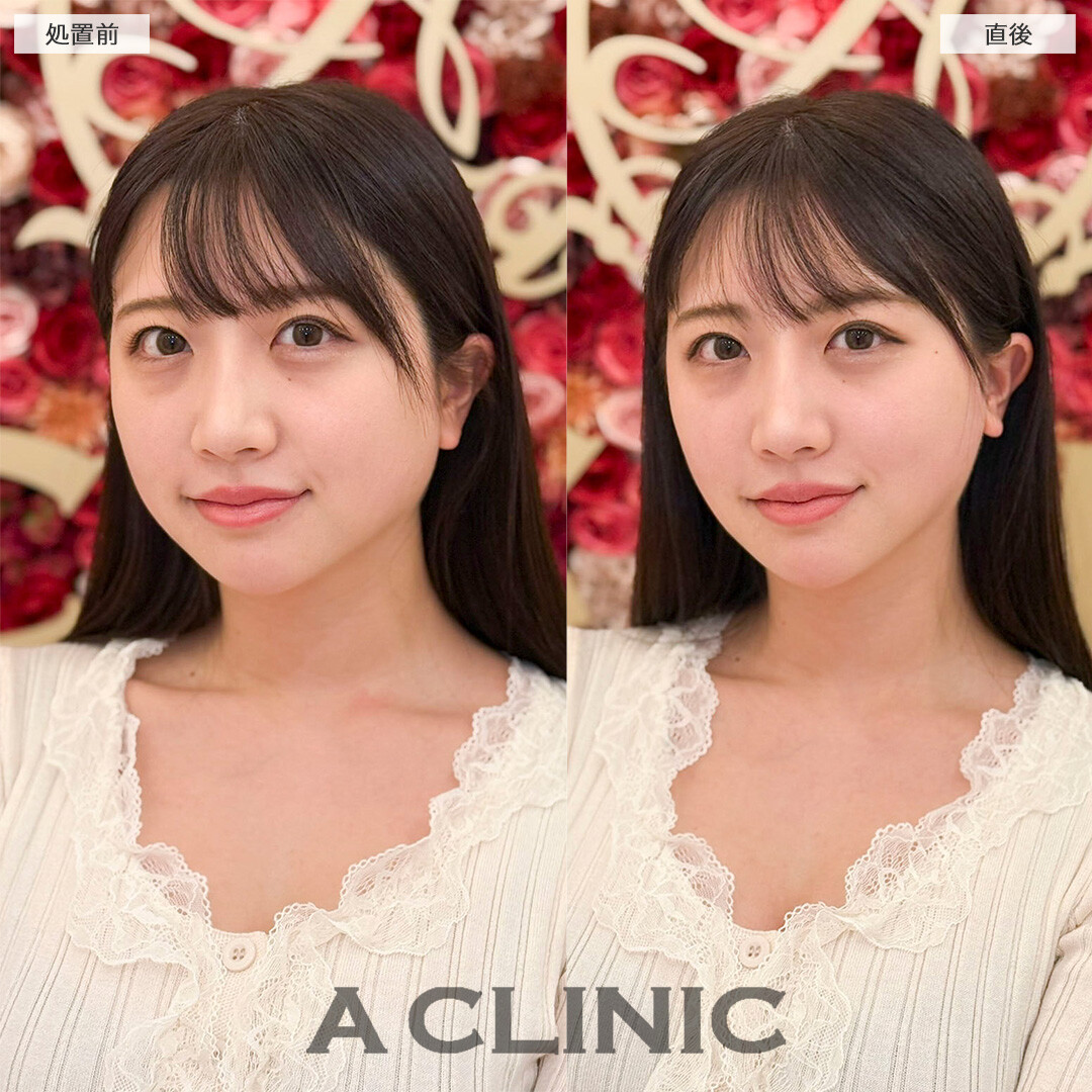 Aスレッドで自然に痩せたようなフェイスラインに！処置前と直後の症例です(30代女性)