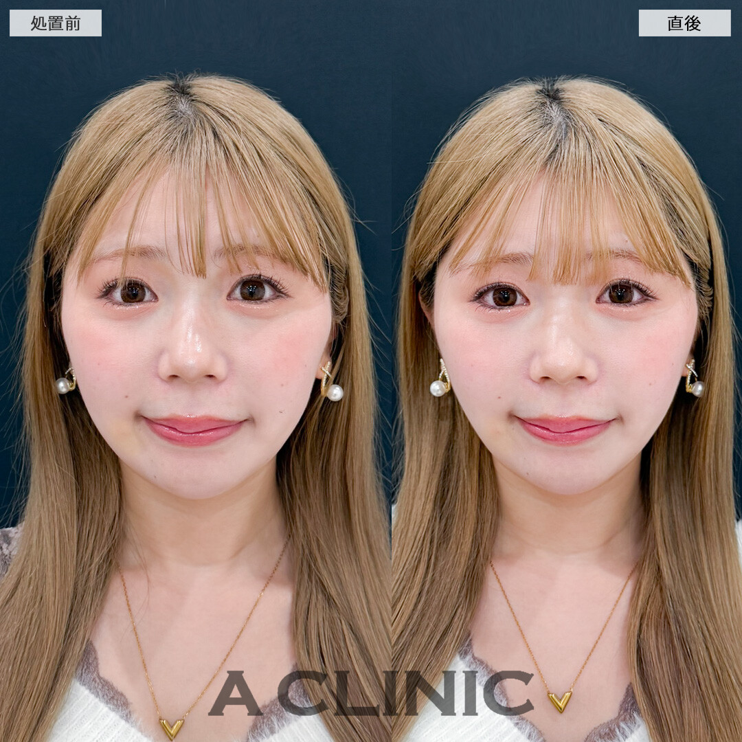 Aスレッドで年々気になる口横やフェイスラインのもたつきをスッキリさせてたるみ予防に！処置前と直後の症例です(30代女性)