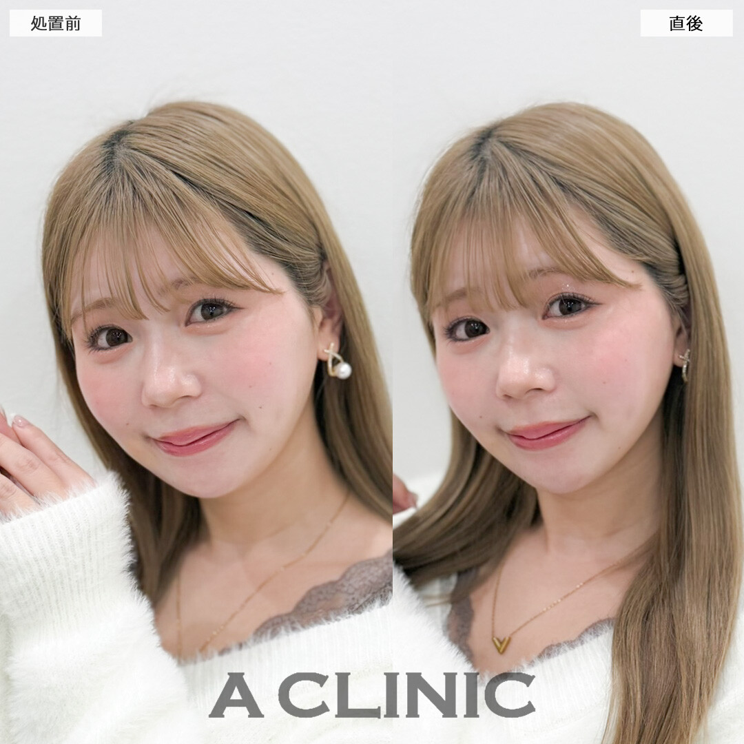 Aスレッドで年々気になる口横やフェイスラインのもたつきをスッキリさせてたるみ予防に！処置前と直後の症例です(30代女性)