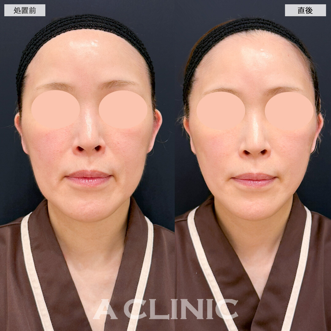 Aスレッドで最短で若見え効果を発揮します！処置前と直後の症例です(50代女性)