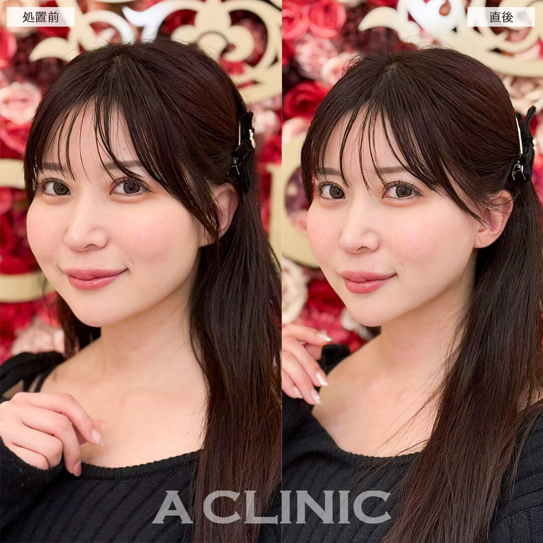 Aスレッドでたるみにくい輪郭へ！処置前と直後の症例です(30代女性)