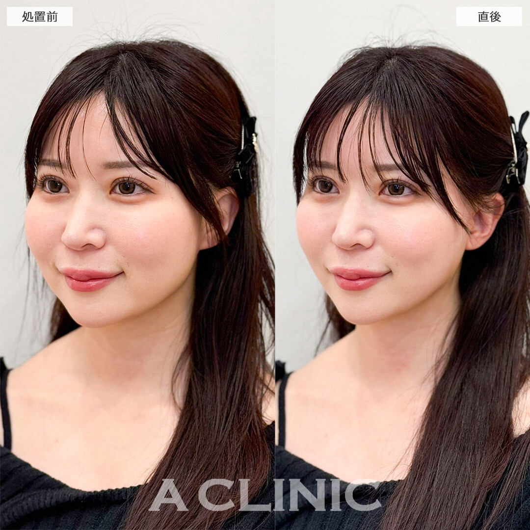 Aスレッドでたるみにくい輪郭へ！処置前と直後の症例です(30代女性)