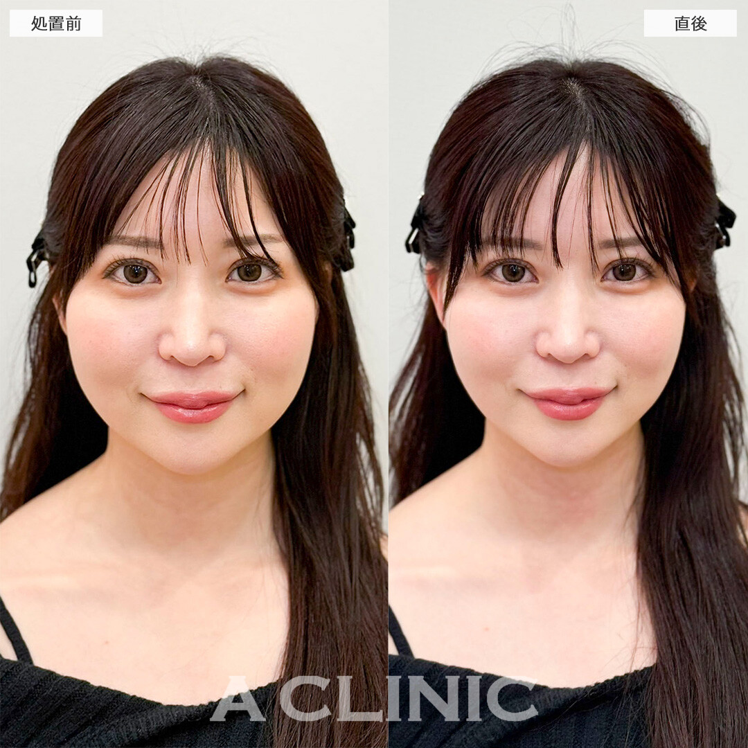 Aスレッドでたるみにくい輪郭へ！処置前と直後の症例です(30代女性)