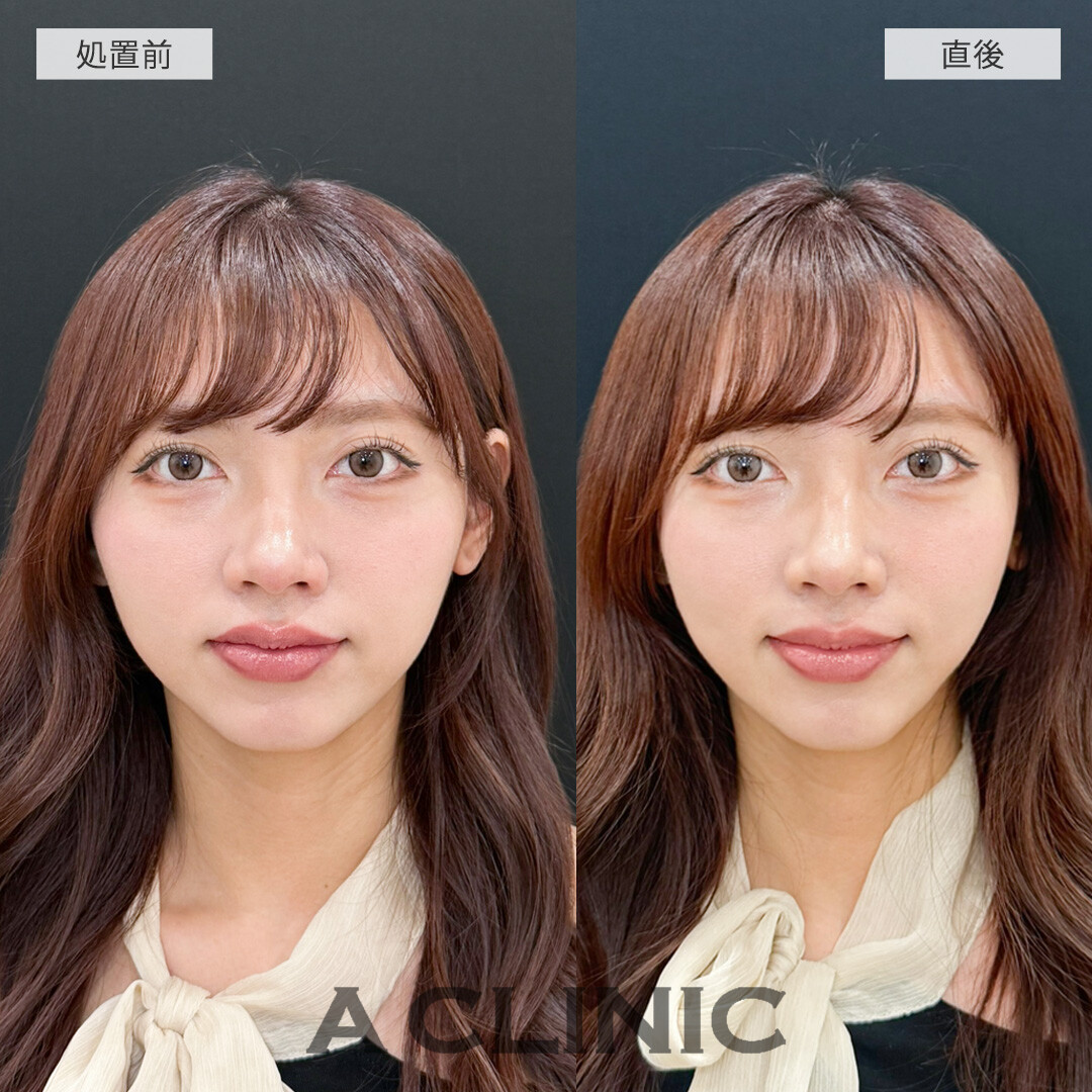 Aスレッドで輪郭のぼやけた感じがなくなって垢抜け！こちら処置前と直後の症例です(20代女性)