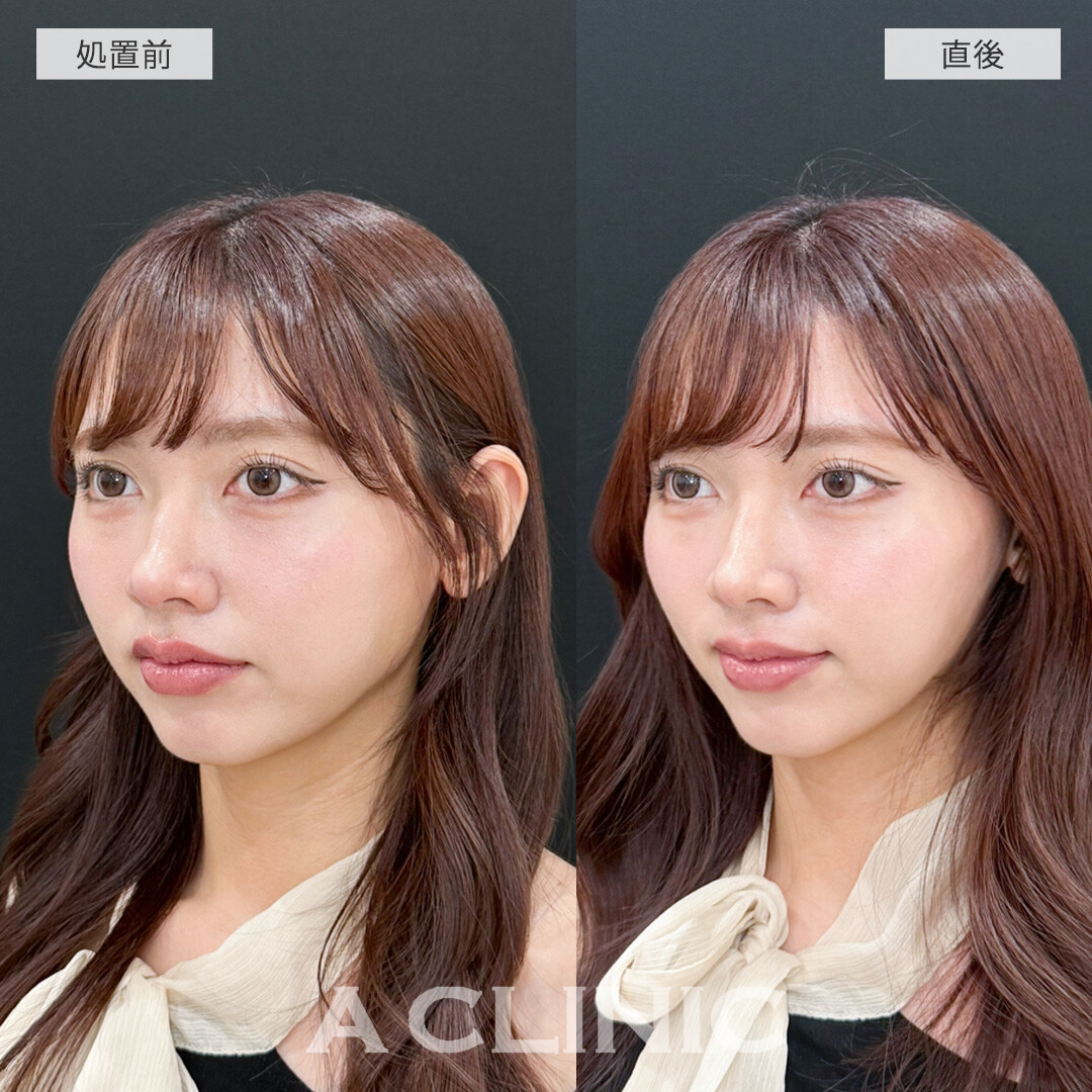 Aスレッドで輪郭のぼやけた感じがなくなって垢抜け！こちら処置前と直後の症例です(20代女性)