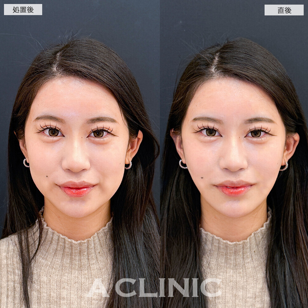 Aスレッドで口横のもたつきがなくなり綺麗な卵型の輪郭に！こちら処置前と直後の症例です(20代女性)