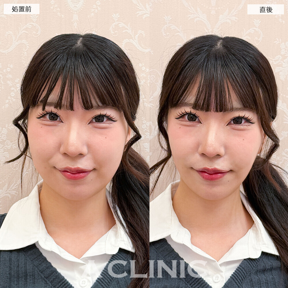 Aスレッドで口横のもたつきスッキリ！こちら処置前と直後の症例です(20代女性)