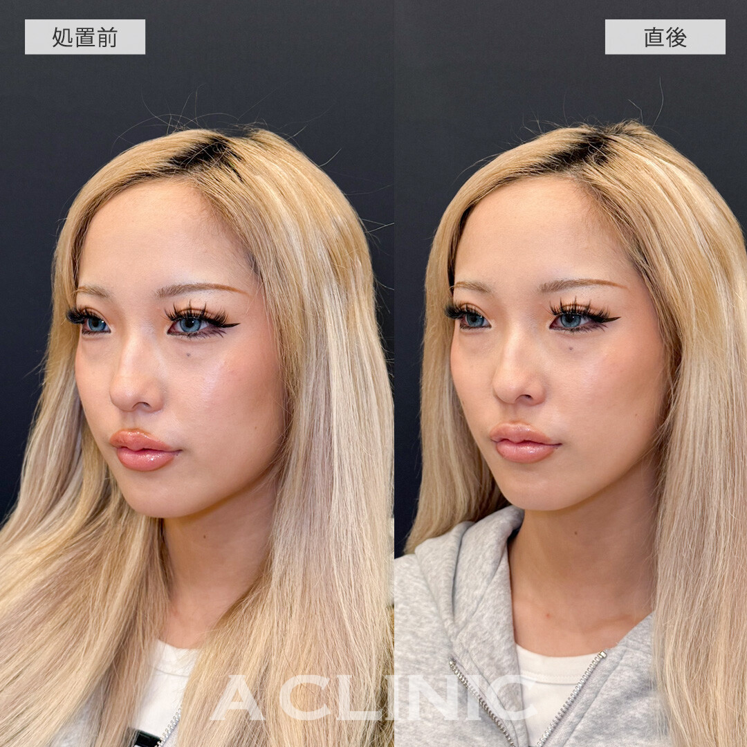 Aスレッドで直後から憧れのVフェイスにアップデート！こちら処置前と直後の症例です(20代女性)