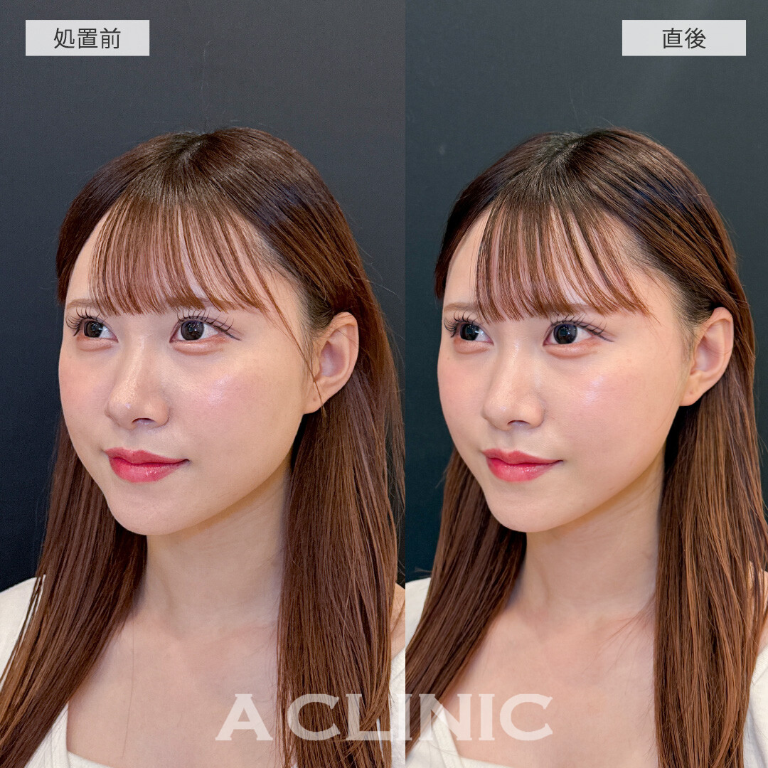 Aスレッドでナチュラルかつしっかりとリフトアップして垢抜け！こちら処置前と直後の症例です(20代女性)