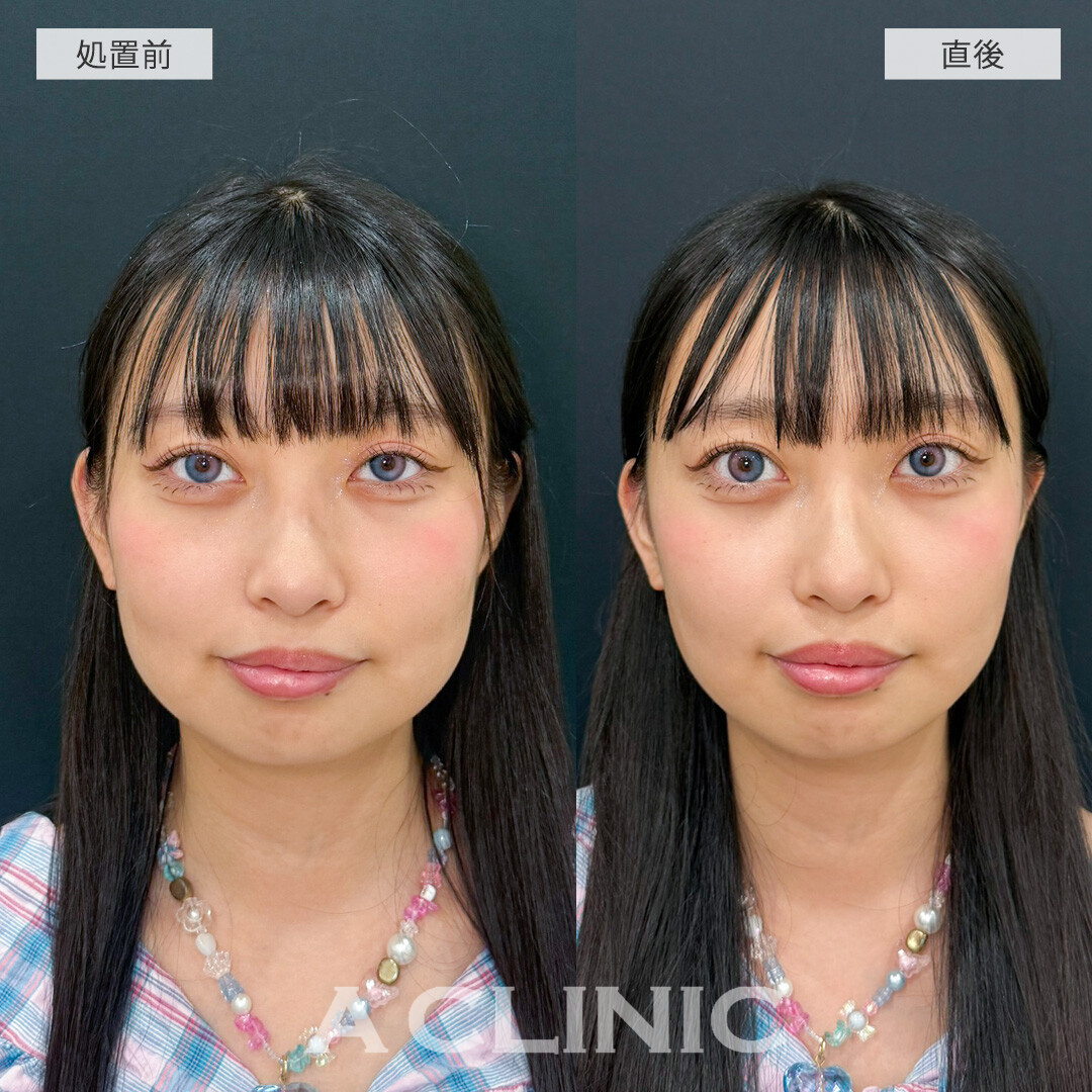 Aスレッドで直後から丸顔改善！こちら処置前と直後の症例です(20代女性)