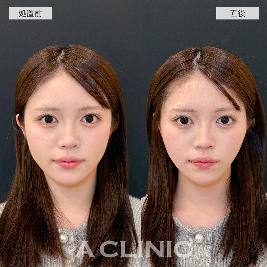 Aスレッドで直後からスッキリした輪郭に大変身！こちら処置前と直後の症例です(20代女性)