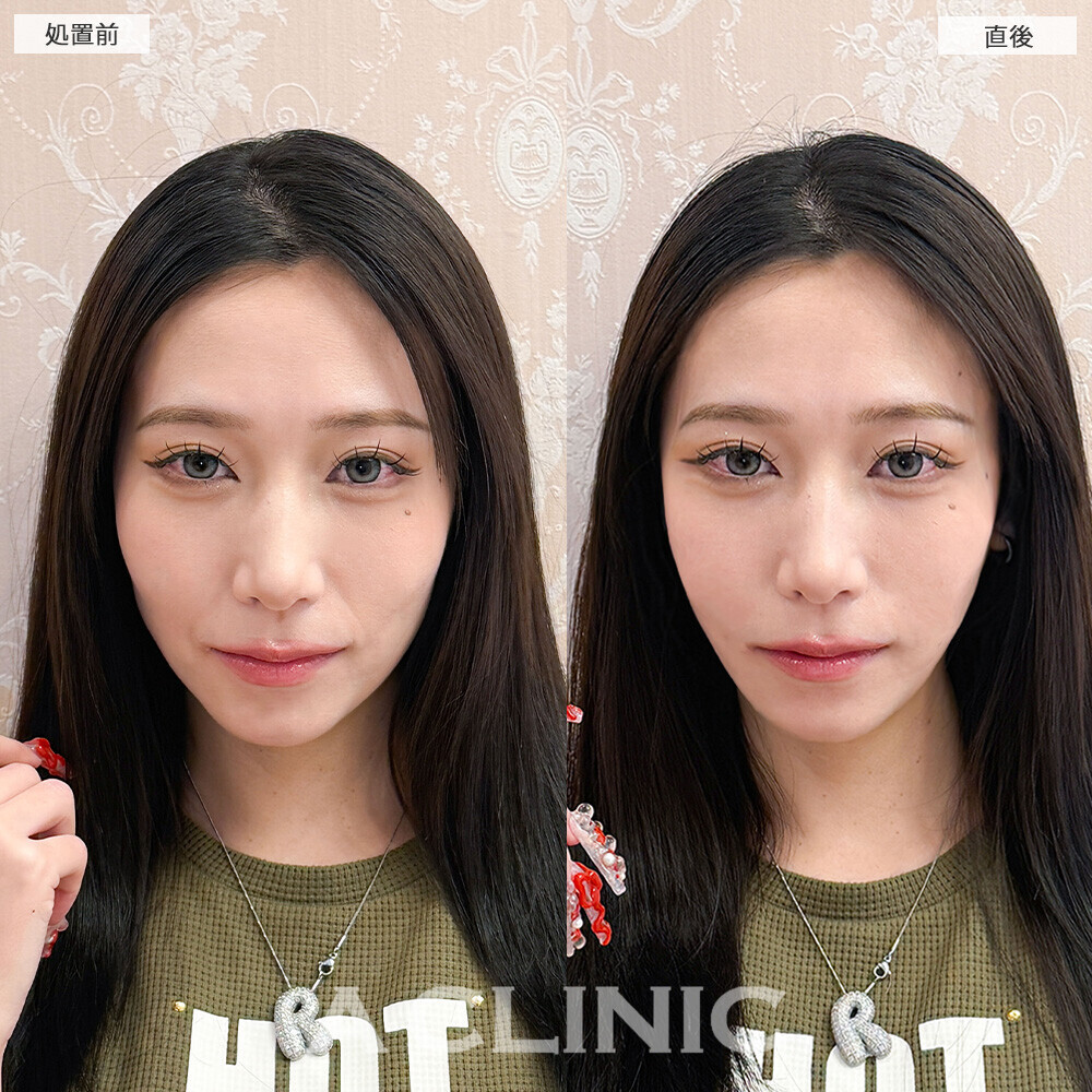 Aスレッドで顔の余白感改善！こちら処置前と直後の症例です(20代女性)