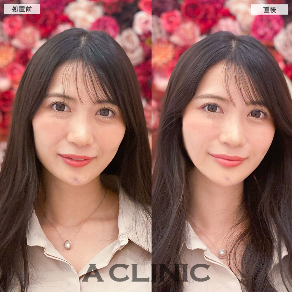 Aスレッドできゅっとリフトアップ！処置前と直後の症例です(20代女性)