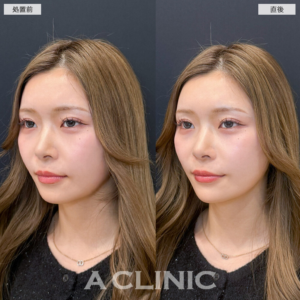 Aスレッドでバブみを残しながらもフェイスラインのもたつきを解消しました！こちら処置前と直後の症例です(20代女性)