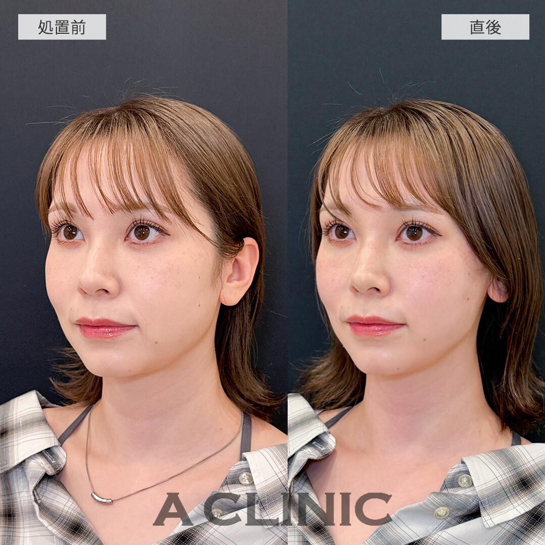 ダウンタイム最小限でたるみを解消してシュッとした輪郭に！Aスレッドの処置前と直後の症例です(30代女性)