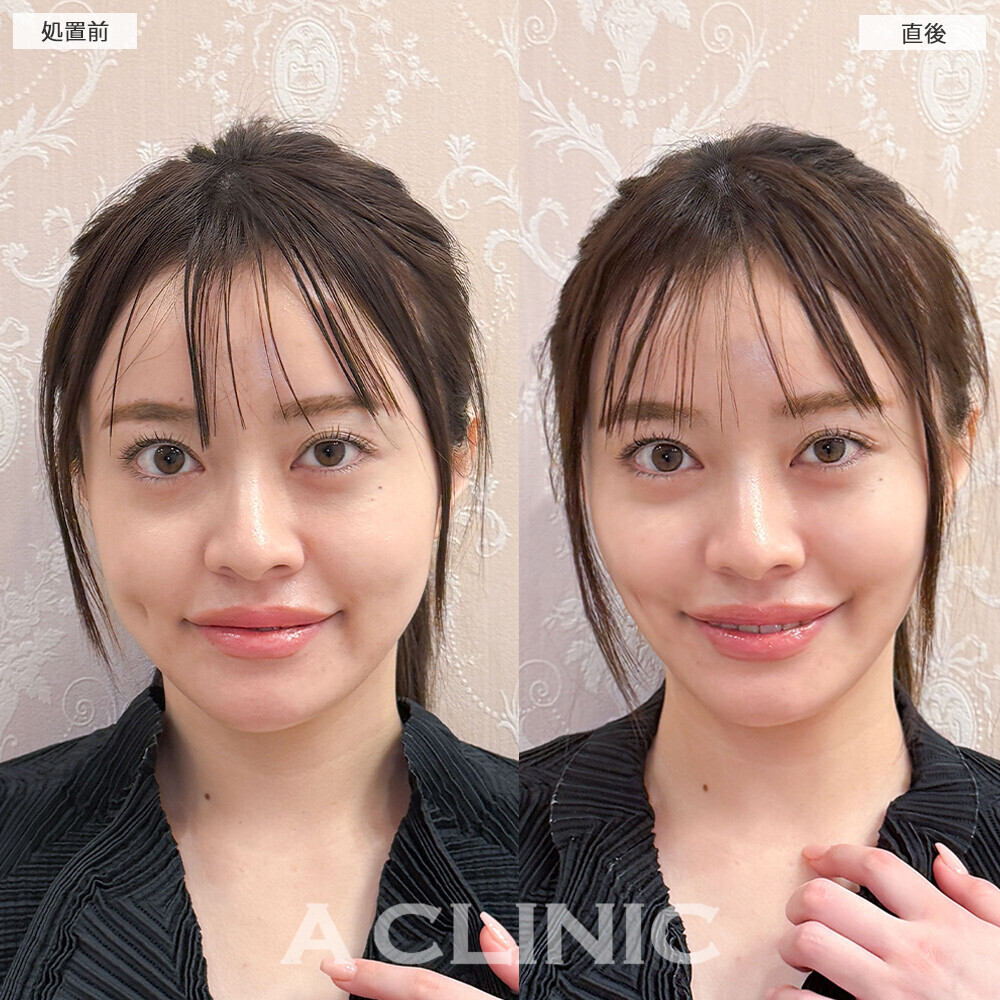 Aスレッドでフェイスラインの左右差や凹凸を改善！こちら処置前と直後の症例です(20代女性)