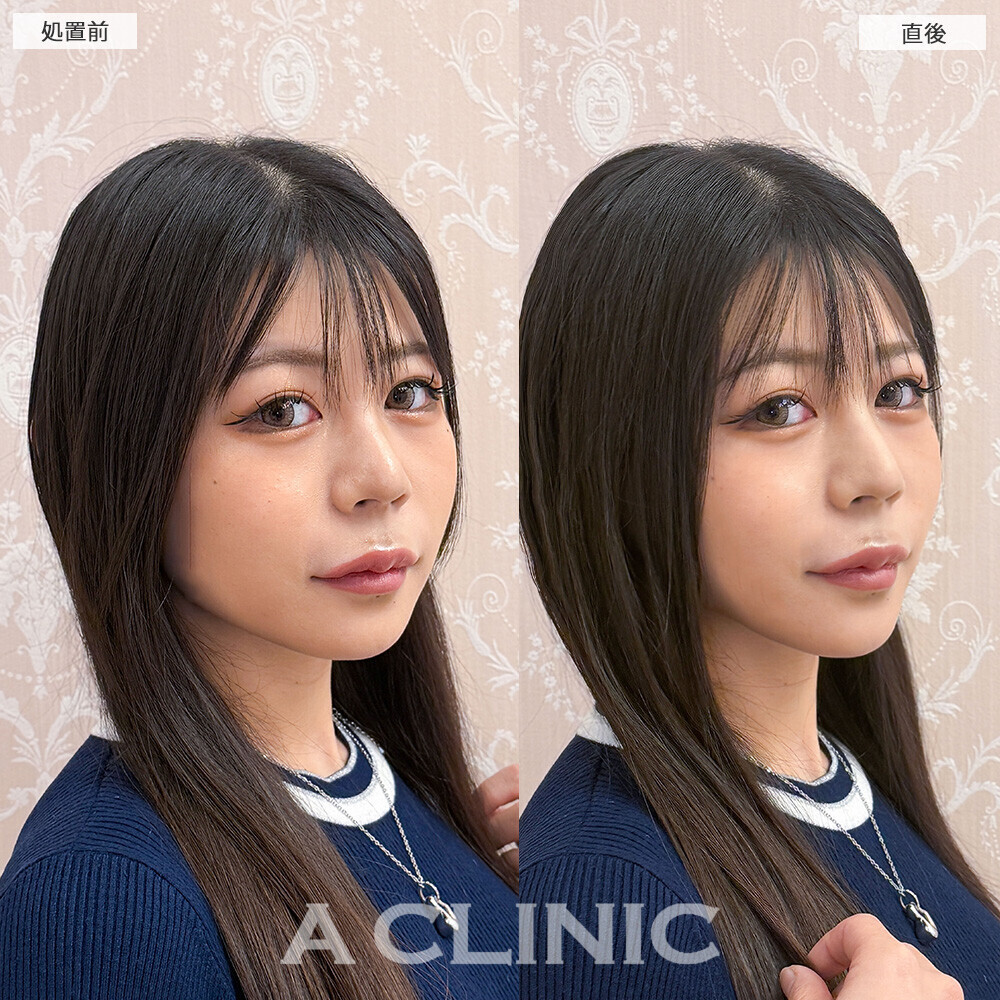 Aスレッドで下膨れ顔が一気にリフトアップ！こちら処置前と直後の症例です(20代女性)