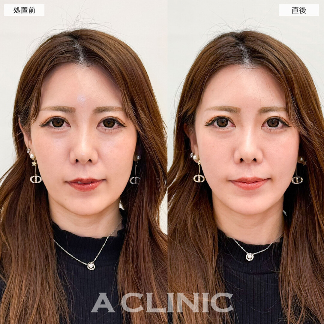 Aスレッドでほうれい線や左右差も改善されました！こちら処置前と直後の症例です(30代女性)