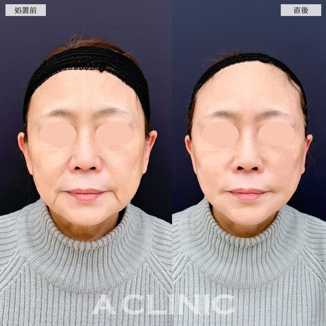 Aスレッドで口横のシワが改善され若見え成功！こちら処置前と直後の症例です(60代女性)