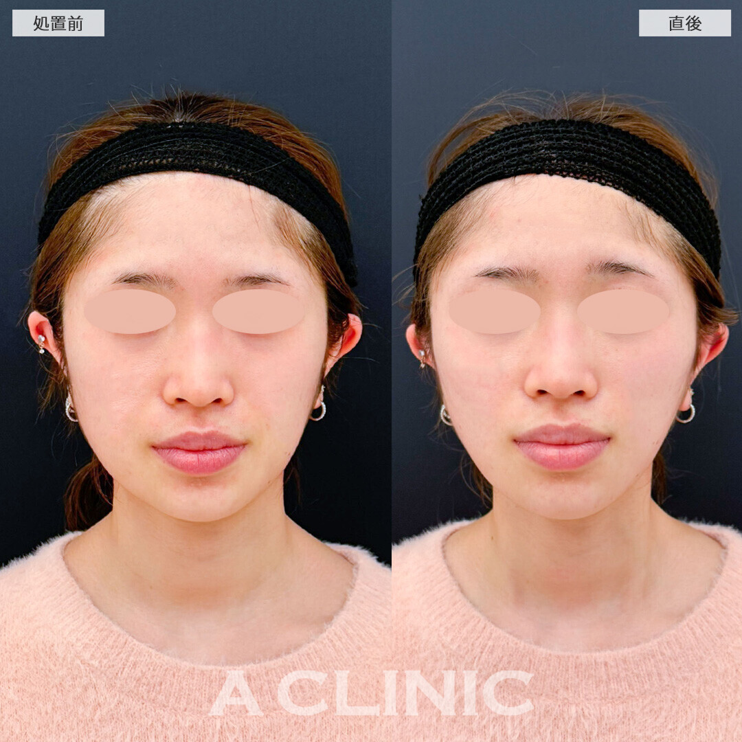 Aスレッドで左右差とたるみが改善されました！こちら処置前と直後の症例です(20代女性)